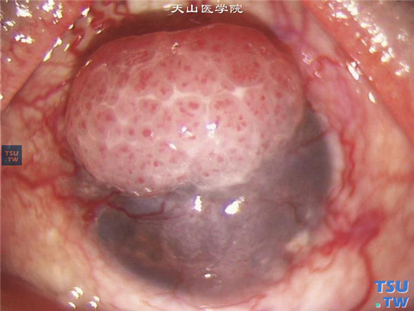 角膜鳞状上皮细胞癌，可见肿瘤凸出角膜表面，呈菜花状外观，伴有丰富的新生血管