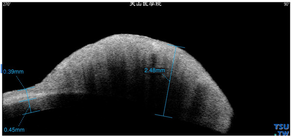 角膜鳞状上皮细胞癌，同一患者，Visante OCT检查，可见角膜表面半球形肿物，肿物厚度为2.48mm