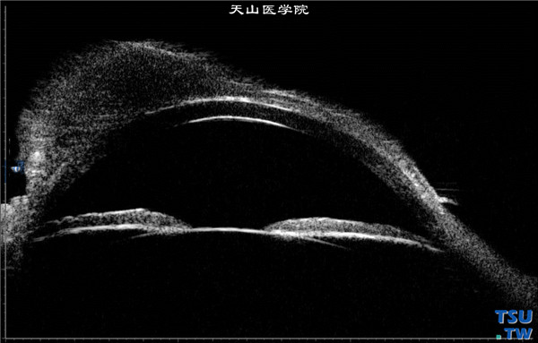 角膜鳞状上皮细胞癌，同一患者，超声生物显微镜检查，可见角膜表面半球形肿物，房角开放可
