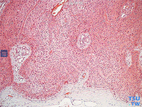 角膜鳞状上皮细胞癌，HE ×100