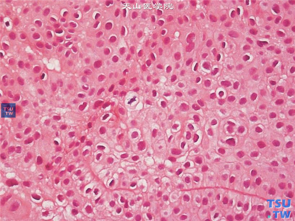 HE×400，上述角膜鳞状上皮细胞癌患者，术中获取病变组织行组织病理学检查，HE染色显示角膜鳞状细胞乳头状增生，突破基底膜，细胞层次明显增多，细胞增生活跃，可见多个细胞核分裂象