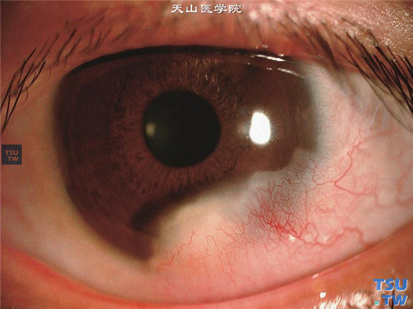角膜纤维组织细胞瘤，可见角膜颞下方有膜状新生物长入，表面血管丰富
