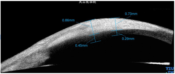 角膜纤维组织细胞瘤，同一患者，Visante OCT检查，显示病变处角膜表面有高密度的影像，尚未累及角膜内皮层