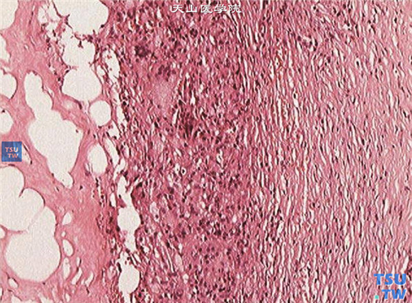 角膜纤维组织细胞瘤，HE ×100