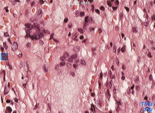 HE×400，以上两张图片显示上述纤维组织细胞瘤患者，术中获取病变组织行组织病理学检查，HE染色可见角膜基质板层纤维细胞增生，组织细胞浸润，胞浆丰富，呈泡沫状，可见多核巨细胞