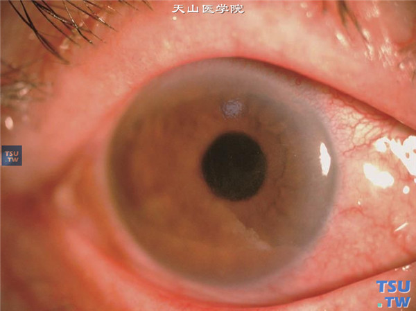 糖尿病性角膜病变，患者糖尿病病史16年，右眼结膜充血，角膜上皮粗糙和缺损