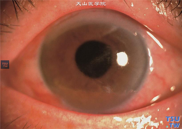 糖尿病性角膜病变，同一患者，左眼结膜充血，角膜上皮脱失