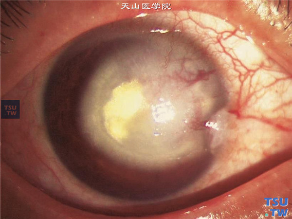 梅毒性角膜基质炎，睫状充血，中央区角膜基质水肿混浊，伴有脂质样变性，呈黄白色，深层新生血管明显