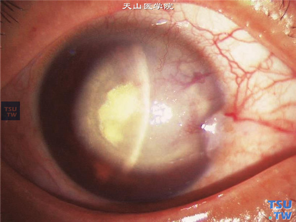 梅毒性角膜基质炎，同一患者，裂隙灯显微镜检查，可见角膜基质明显混浊水肿，角膜内皮层界线视不清，血管位于深层