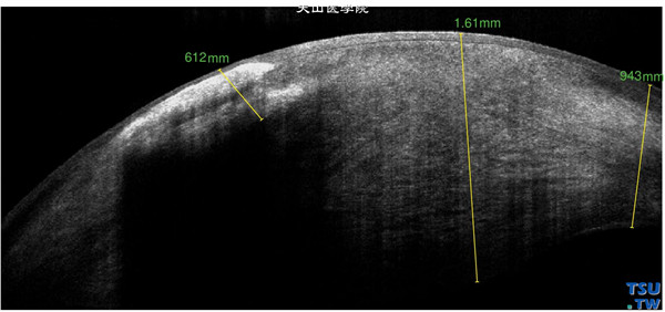 梅毒性角膜基质炎，同一患者，RTvue OCT检查，角膜基质混浊水肿，厚度为1.61mm，可见脂质样变性区有更高密度的影像，角膜上皮层完整