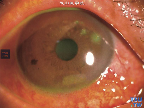 甲状腺相关性眼病，甲亢病史5年，同一患者，可见角膜丝状分泌物，下方角膜溃疡，荧光素钠染色阳性