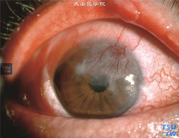 甲状腺相关性眼病，甲亢病史7年，排除白塞病、天疱疮，右眼眼球前突，混合充血，大量新生血管伸入角膜