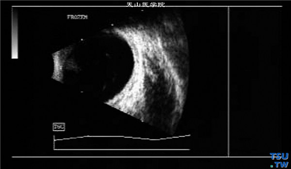 甲状腺相关性眼病，甲亢病史7年，左眼B型超声检查，可见眼外肌呈明显梭形肥厚，回声明显降低