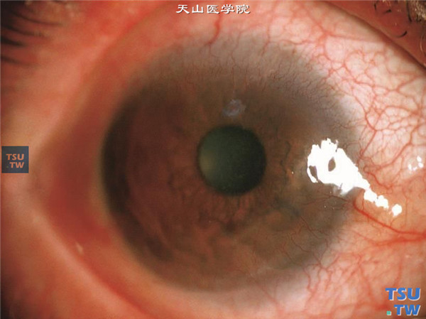 酒渣鼻性角膜炎，右眼结膜充血，新生血管长入角膜内，角膜干燥，角膜上皮损害