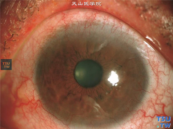 酒渣鼻性角膜炎，同一患者，左眼结膜充血，角膜缘出现浅层新生血管，伴有睑缘炎