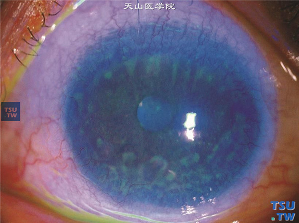 酒渣鼻性角膜炎，左眼角膜荧光素钠染色阳性，可见点片状角膜上皮缺失