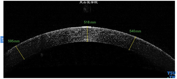 酒渣鼻性角膜炎，左眼RTvue OCT检查，可见角膜上皮层欠光滑，呈点状高密度影像