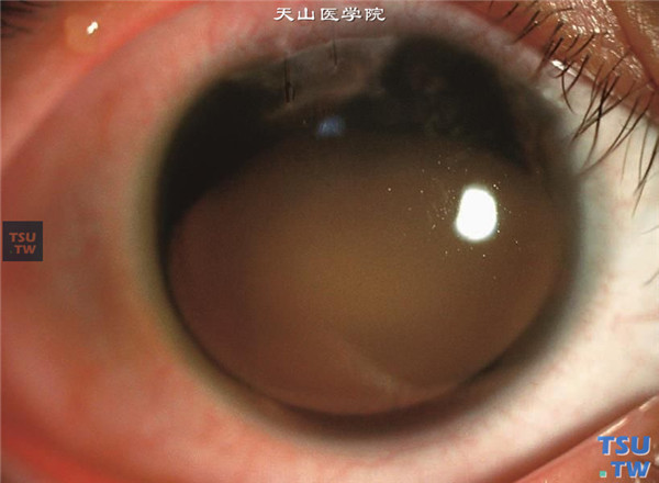 角膜血染，被鞭炮炸伤3月余，可见上方角膜缝线在位，角膜血染，瞳孔散大