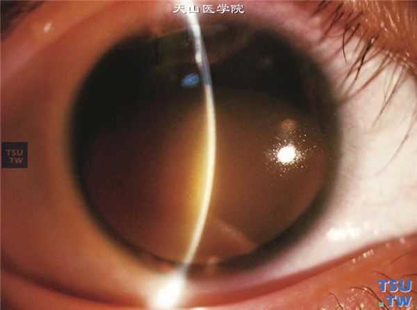 角膜色素沉着（血染、铁质沉着、碘沉着）症状图解
