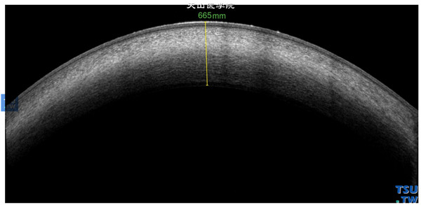 角膜血染，同一患者，RTvue OCT检查，可见角膜血染达角膜深基质层