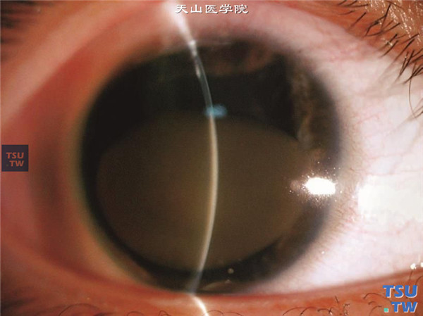 以上两张图片显示该患者经过螯合剂治疗3个月，角膜血染吸收明显，上方角膜变透明，血染色泽变淡