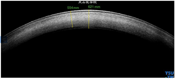 角膜血染，治疗后RTvue OCT检查，可见角膜血染减轻，影像密度变淡，上皮层和内皮层界线完整