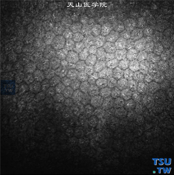 角膜血染，治疗后，临床共聚焦显微镜检查，可见上方透明区角膜内皮细胞边界清楚，细胞形态均匀，细胞密度为每平方毫米1734个