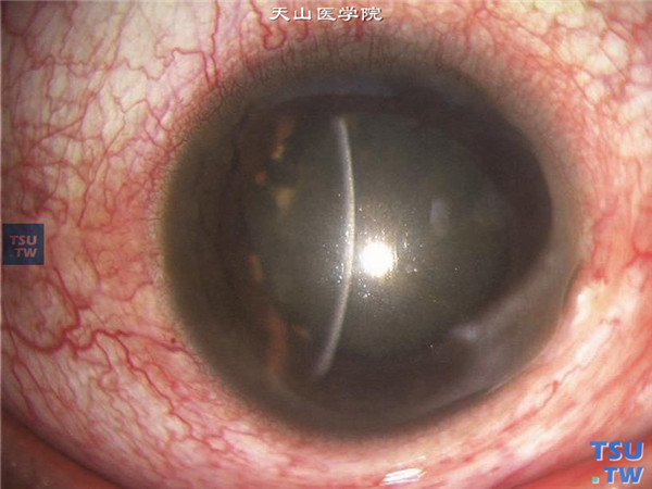铁锈症，图示眼内铁质异物，虽然取出，但角膜仍被锈染，不能消退，结膜充血，角膜基质水肿