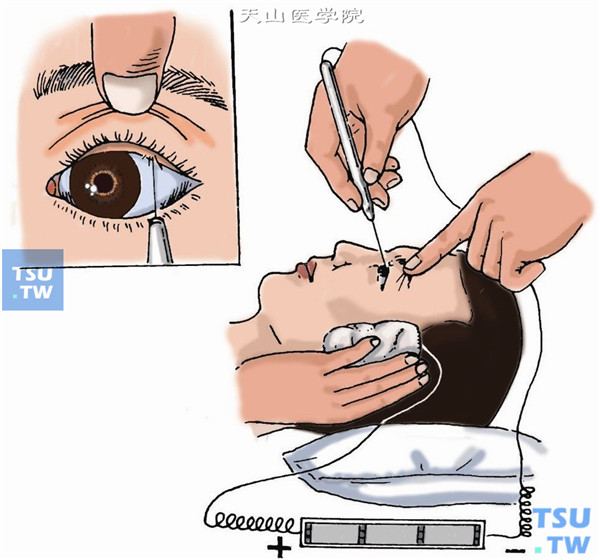 倒睫手术：倒睫电解术步骤图解及注意事项