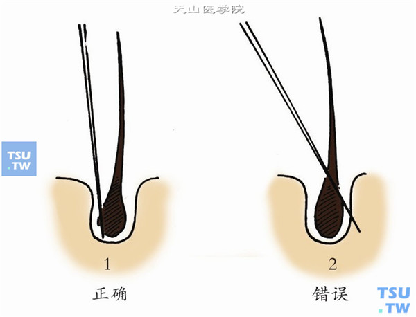 倒睫电解术正确操作：将阴极电解针紧靠毛根，顺着睫毛生长方向刺入毛囊，深约2～3mm