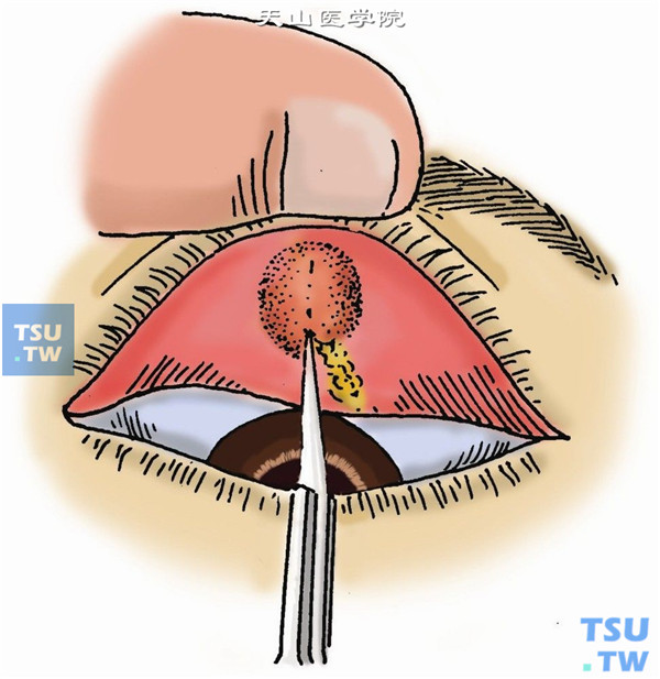 内麦粒肿切开法：翻转眼睑，用尖刀片，其刀刃与睑缘垂直，向睑缘方向切开脓点。用抗生素眼液冲洗结膜囊