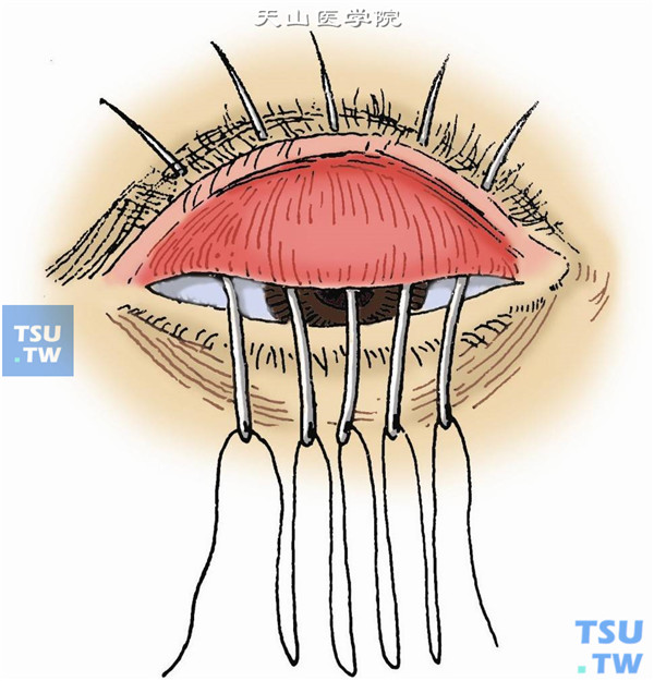 睑板切断缝线术：翻转上睑，暴露上睑穹窿部结膜，用5-0丝线，用带线针从穹窿部结膜进针，经睑板前、距睑缘3mm皮肤面穿出，穹窿部进针的针距离约5mm，以同样方法做3～5对褥式缝线