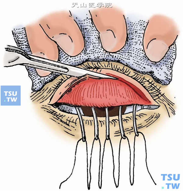 睑板切断缝线术：在距睑缘2～3mm的睑板下沟处，切开睑结膜及睑板，根据内翻程度决定切开深度。切口与睑缘平行，长度约与睑板相等。