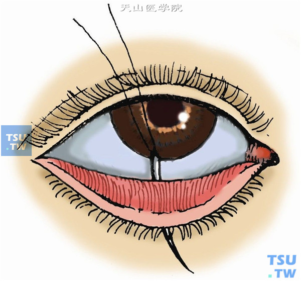 用5-0或1-0丝线，或5-0可吸收缝线，做褥式缝合。先从下睑中央穹窿部结膜进针，经筋膜、眶隔及睑板前，在距睑缘2～3mm处皮肤出针。穹窿部结膜进针间距为3～5mm。