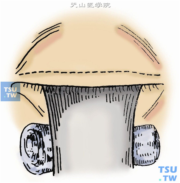 睑板楔形切除术步骤及临床经验