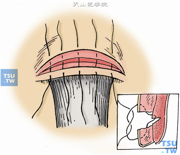 用5-0丝线行间断缝合，一般5针，多从中间一针开始。次序为：切口下缘皮肤→睑板切口上缘→切口上缘皮肤。先结扎中间缝线，松紧适度，调整睑缘形态，对合皮肤防止翻转向内影响愈合