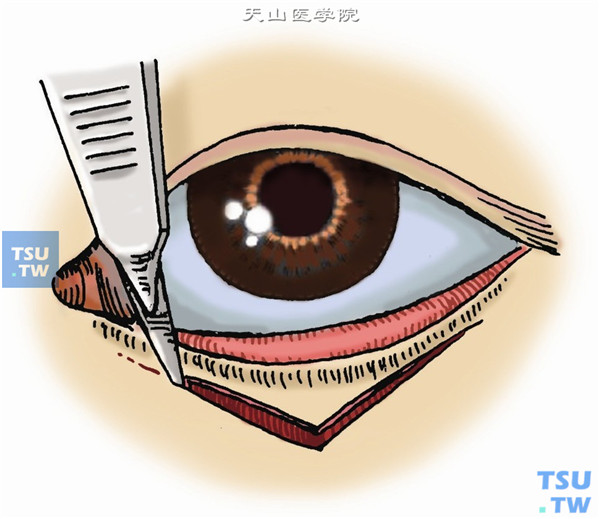 眼部V-Y成形术步骤及临床经验