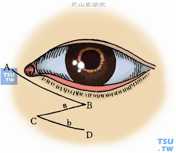 用美蓝标记切口：沿瘢痕牵引线标记主轴线，在其两端各作一条互相平行的斜线，斜线与主轴线夹角以60°为宜。如＞70°，皮瓣转位困难，且容易造成较大的“猫耳”。皮肤第一切口AB，距内眦1mm，向下平行睑缘，直至下睑长度的3/5；皮肤第二切口BC，从B点向内，经瘢痕的下缘，斜向内下方，长约1.5cm；皮肤第三切口CD，从C点起，与AB平行，长约2cm（下图）