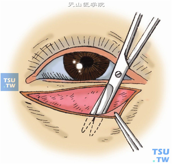 眼部游离植皮术步骤及临床经验