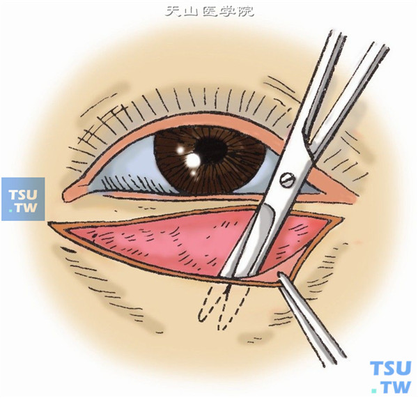 距睫毛3mm，与睑缘平行切开皮肤，达瘢痕组织浅表面，在皮肤和瘢痕之间潜行分离（图1）