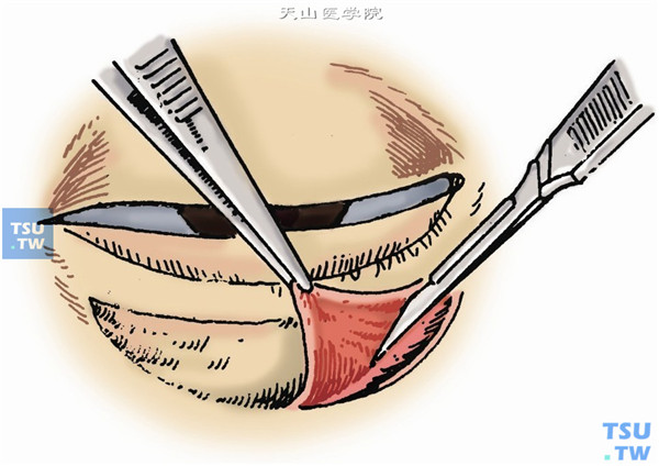 将创面内及皮下瘢痕组织全部切除，直至眼睑恢复正常位置，充分压迫止血。如有动脉性出血可用5-0丝线结扎止血（图2）