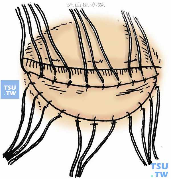 缝合。取下的全厚皮片贴敷于眼睑缺损处，如有多余，应予剪除，使皮片边缘能自然和创缘对合。用4-0丝线缝合皮片两角，以作固定。缝合针距约3mm，应从皮片侧进针，以防皮片移动。间隔2～3针，线头留长，以做结扎加压敷料（图5）。