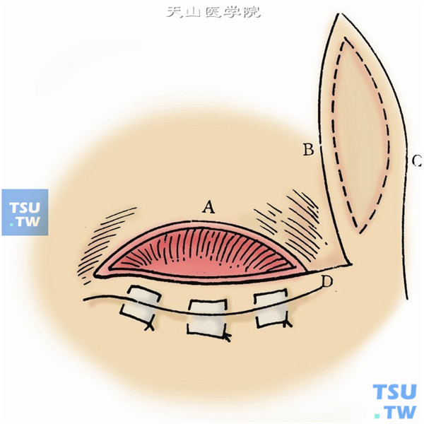 在受皮区切口A（笫一切口）外侧端外1～1.5cm向上作切口B（第二切口），比A长1/3，从B上端向外下方作切口C（第三切口），比B长1cm。B、C两切口之间的宽度比皮肤缺损区宽1/3。将A切口外端与B切口下端连接成D切口。各切口均切至皮下，分离皮下组织，形成有蒂皮瓣（图1）