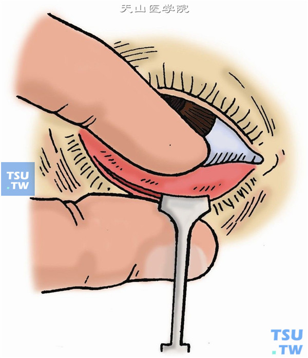 用拇指和食指固定下睑或用金属角膜保护板插入结膜囊内固定睑缘部，用尖刀沿灰线将下睑外2/3劈成两叶。前叶为皮肤及肌肉，后叶为睑板及结膜。切开深度约1cm，达睑板下缘（图1）