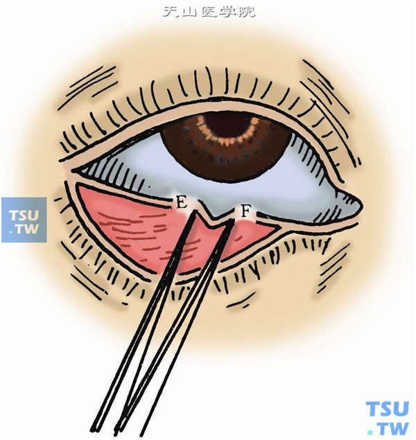 切除部分后叶。先在后叶中央部用镊子将后叶对折，以能使睑缘紧贴眼球为度，宽度为EF。切除一个睑结膜、睑板小三角，其基底位于睑缘（图2）