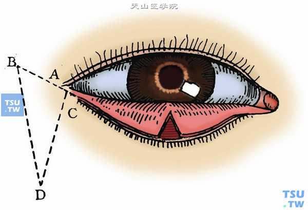 在外眦切开的外端A处，顺着下睑弧线向外上延长，切开皮肤AB，其长度与EF相等或稍长2～3mm。再从外眦角向外下与AB垂直作等于AB两倍的CD切口，连接AB与CD两切口之终端，作第三切口BD。切除ABD三角形皮肤（图3）
