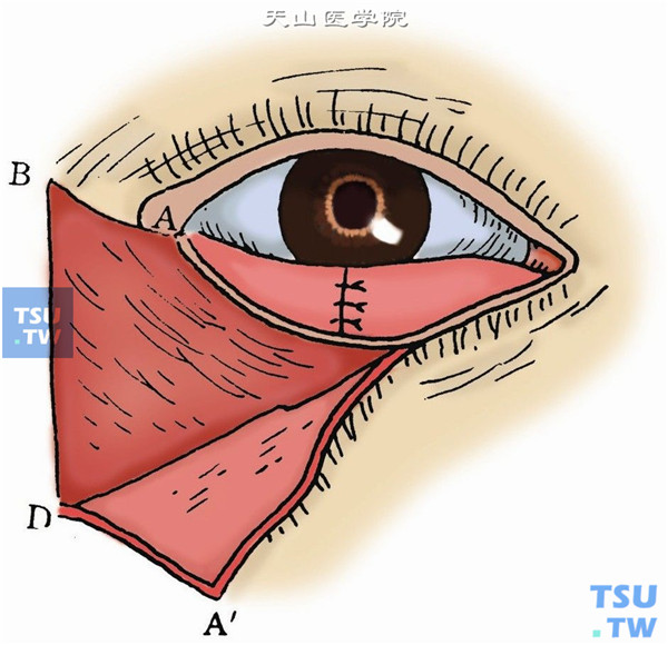 用5-0丝线缝合睑板三角形创面，先缝三角尖端，次缝中间，再缝基底，对合睑缘（图5）