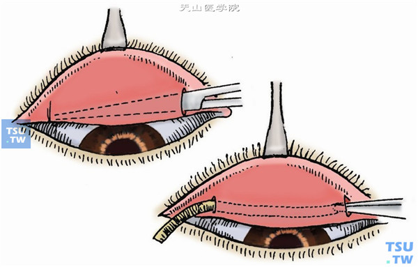 用眼睑拉钩翻转上睑暴露上穹窿结膜，在穹窿部结膜下（进针要浅）注入2%利多卡因0.5ml，使Müller肌与穹窿部结膜分离。在内外侧穹窿部结膜各做长5mm的纵形切口，用钝头剪刀（或虹膜整复器）伸入切口结膜下，将穹窿部结膜与Müller肌分离，置入橡皮片，穿出内外眦部结膜（图1）