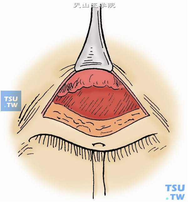 切除切口下唇眼轮匝肌一条。用开睑钩将切口上唇皮肌层向前牵引，可见腱膜前间隙（充满脂肪）与腱膜之间出现一沟状凹，用剪刀沿此沟向上分离，将腱膜前面与眶隔分开。如眶隔打开，有脂肪脱出，可用拉钩将脂肪压向上方，或用双极电镊烧灼脱出的眶脂。眶脂退回后，即可暴露提上睑肌腱膜。或左右打开眶隔，切除或烧灼眶脂，使眶脂后退，可清晰暴露提上睑肌腱膜（图4）