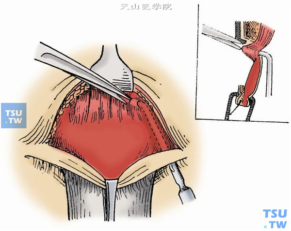 在充分暴露提上睑肌腱膜后，用斜视钩在睑板上缘上方从结膜面顶起提上睑肌腱膜，在近外眦部纵行切开腱膜，向后分离直至暴露橡皮条（图5）